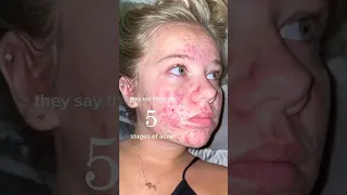 ACNE SKINCARE ROUTINE!😱(follow for more!💗) #acne #acnetreatment #skincare #skincareroutine #beauty