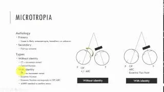 Microtropia Characteristics