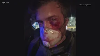 Journalist shot in the face with impact munition by federal agents during Portland protest