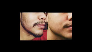 Minoxidil Beard 2 Months Transformation (No Genetic)