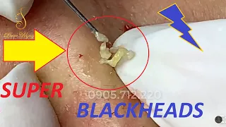 SUCCESSION_when removel BLACKHEADS  and ACNE PORES for customer (23) | Loan Nguyen