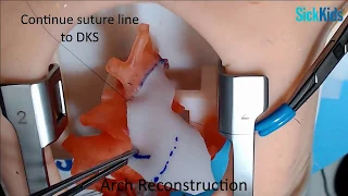 HOST - Norwood operation (Interdigitating technique) on 3D printed model - Dr O Honjo