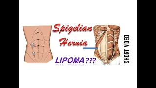 Spigelian hernia. Misdiagnosis (initial diagnosis - lipoma ?) - Грыжа Спигелевой линии (липома ?).