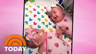 Separated conjoined twins heading home after successful surgery