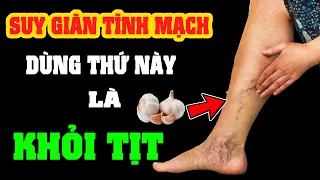 Suy Giãn Tĩnh Mạch Nặng Mấy Cũng Hết Nhờ Thứ RẺ TIỀN Này, Không Cần Đến B/ệnh Viện