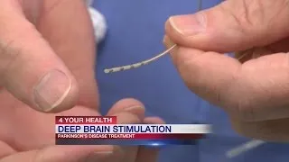 Deep brain stimulation procedure has high success rate for patients with Parkinson's Disease