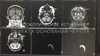 Эндоскопическое устранение дефекта черепа.