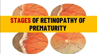 Retinopathy of prematurity Staging