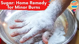 Sugar: A Home Remedy for Minor Burn Relief | My Experience