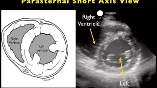 Cardiac Ultrasound - Parasternal Short Axis - Sonosite, Inc.