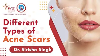 Know About Types of Acne Scars | Dr. Sirisha Singh | SCI Hospital