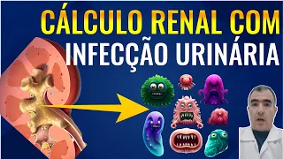 Cálculo renal com infecção urinária: só o antibiótico não vai resolver esse problema