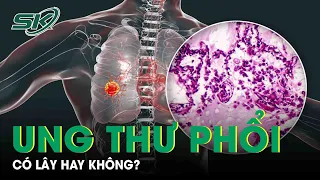 Ung Thư Phổi Có Lây Không? |SKĐS