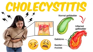 Cholecystitis- Gallbladder Inflammation