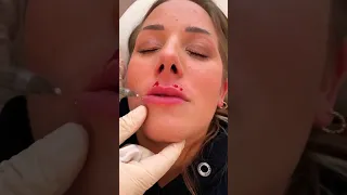 Natürlich aufgespritzte Lippen? 😍 Jetzt ABONNIEREN!