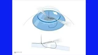 Corneal Suturing, Part 6 - Integrating the Steps Into a Whole