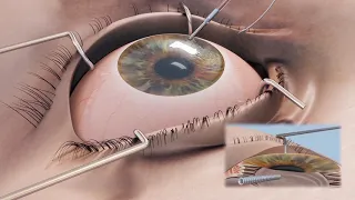 Corneal & Trephines Cornea Graft Transplant Surgical Procedure Cornonet Eye