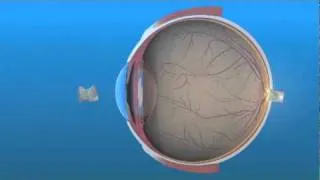 Intraocular Lens (IOL)