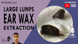 641 - Large Lumps of Ear Wax Extracted