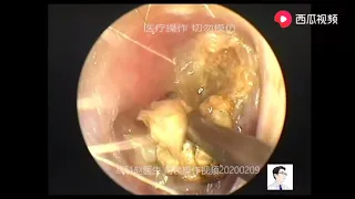 Cholesteatoma with bone destruction of external auditory canal, 9 minutes