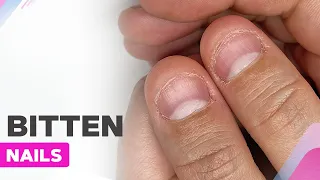 Extremely Bitten Nails Transformation | How to Repair Damaged Nails?