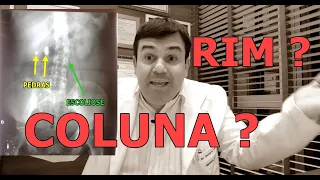 CÓLICA Renal x Dor LOMBAR: Diferenças e Semelhanças que Te CONFUNDEM