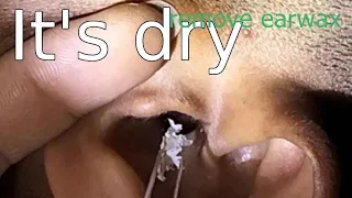 Ear Cleaning Part 113  ear wax removing satisfying everyday