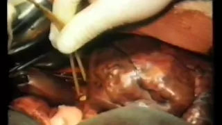 Резекция печени - resection of liver