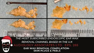 EAR WAX REMOVAL COMPILATION - SKIN PLUGS & PEELS - EP 265