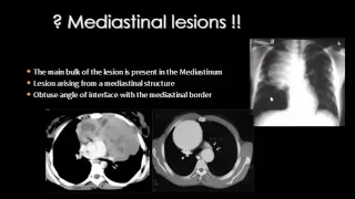 Imaging of mediastinum Dr Mamdouh Mahfouz