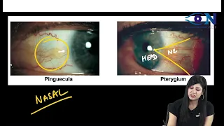 Ophthalmology PYQs_FMGE_36 || Dr. Niha Aggarwal