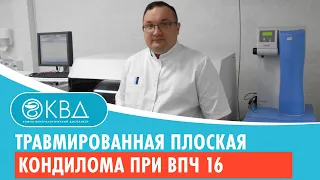 😲 Травмированная плоская кондилома при ВПЧ 16. Клинический случай №549