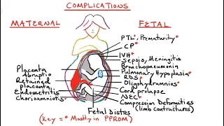 Preterm Premature Rupture of Membranes (pprom) and Chorioamniotis