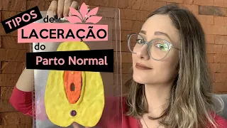 Tipos de laceração do parto normal