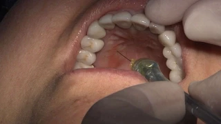 Case of the week: Kathy Bassett Demonstrates the AMSA Injection