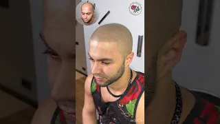 Трихопигментация лучше чем пересадка волос. Трансформация прически. Scalp micropigmentation