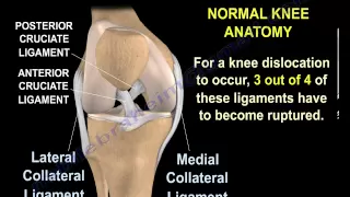 Knee Dislocations - Everything You Need To Know - Dr. Nabil Ebraheim