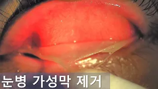 눈병 가성막 제거. Pseudomembrane peeling.