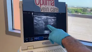 Imaging Venous Reflux of the Greater Saphenous Vein