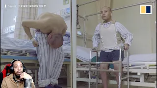 Folded man stands up straight after 28 years following surgery that broke bones TRAP REACTS REACTION