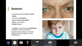 Lecture 7  Cataract