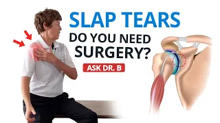 Shoulder Labral Tear / SLAP Lesion: Do You Need Surgery? (Ask Dr. B)