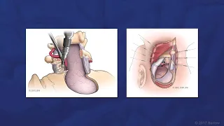 Far-lateral Craniotomy for PICA-PICA Bypass and Trapping of PICA Aneurysm