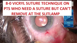 8-0 Vicryl Suture Technique for Children & Disabled Patients Who Can't Get in the Slitlamp