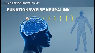 Erstmalige Neuralink-Implantation beim Menschen