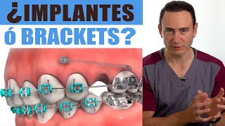 IMPLANTES o BRACKETS ¿Cuál va primero? | ¡EL ORDEN SÍ IMPORTA! | Ortodoncia vs Implantes