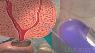 Prostate needle biopsy medical animation