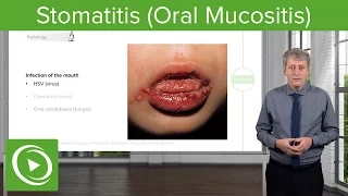 Stomatitis (Oral Mucositis) – Pediatric Infectious Diseases | Lecturio