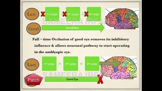 Lecture: "Understanding Strabismus" by Dr. Sameera Irfan, FRCS