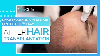 How to wash your hair on the 11th day after hair transplant operation?